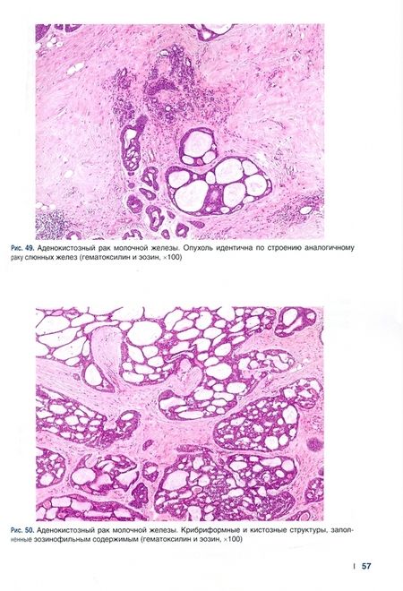 Фотография книги "Рак молочной железы. Морфологическая диагностика и генетика. Руководство для врачей"