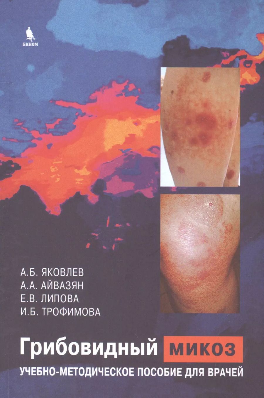 Обложка книги "Алексей Яковлев: Грибовидный микоз. Учебно-методическое пособие для врачей"
