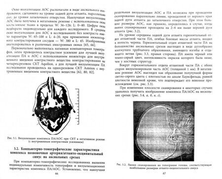 Фотография книги "Калинин, Виноградов, Андреева: Клиническая анатомия комплекса позвоночная артерия/атланто-окципитальный синус"