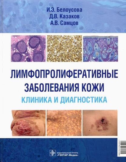 Обложка книги "Белоусова, Самцов, Казаков: Лимфопролиферативные заболеванания кожи. Клиника и диагностика"
