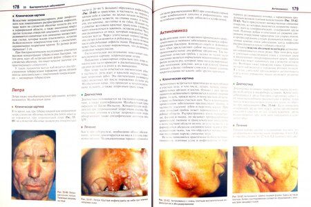 Фотография книги "Борк, Бургдорф, Хеде: Болезни слизистой оболочки полости рта и губ. Клиника, диагностика и лечение"