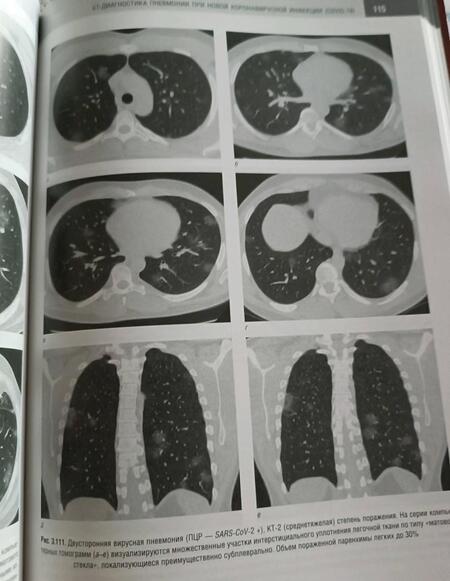 Фотография книги "Геннадий Труфанов: Компьютерная томография в диагностике пневмоний. Атлас"