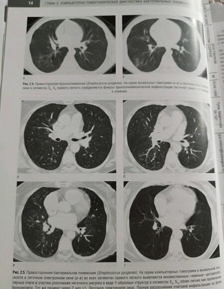 Фотография книги "Геннадий Труфанов: Компьютерная томография в диагностике пневмоний. Атлас"