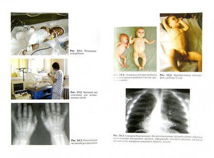 Фотография книги "Григорьев, Харитонова: Детские болезни. Учебник в 2-х томах. Том 1"