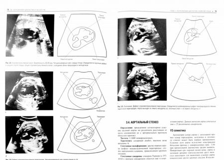 Фотография книги "Иванов, Рязанов, Полякова: Практическая ультразвуковая диагностика. В 5-ти томах. Том 4.Ультразвуковая диагностика в акушерстве"