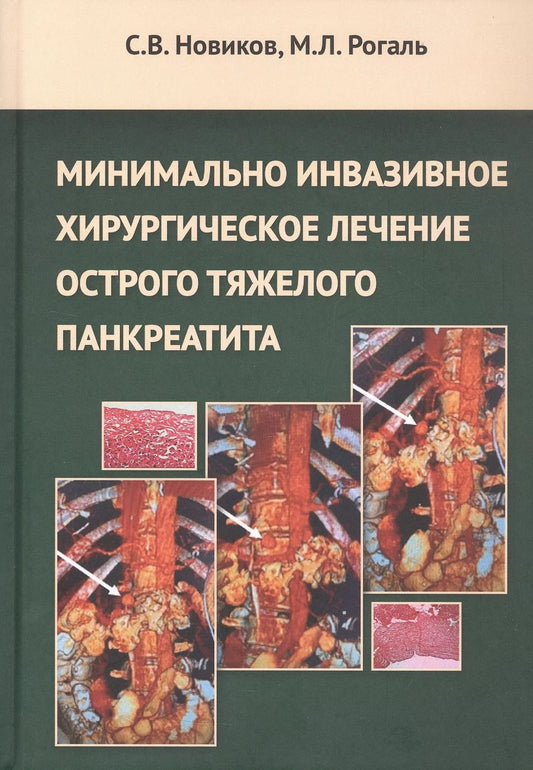 Обложка книги "Новиков, Рогаль: Минимальное инвазивное хирургическое лечение острого тяжелого панкреатита. Монография"