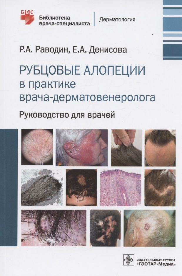 Обложка книги "Раводин, Денисова: Рубцовые алопеции в практике врача-дерматовенеролога. Руководство для врачей"