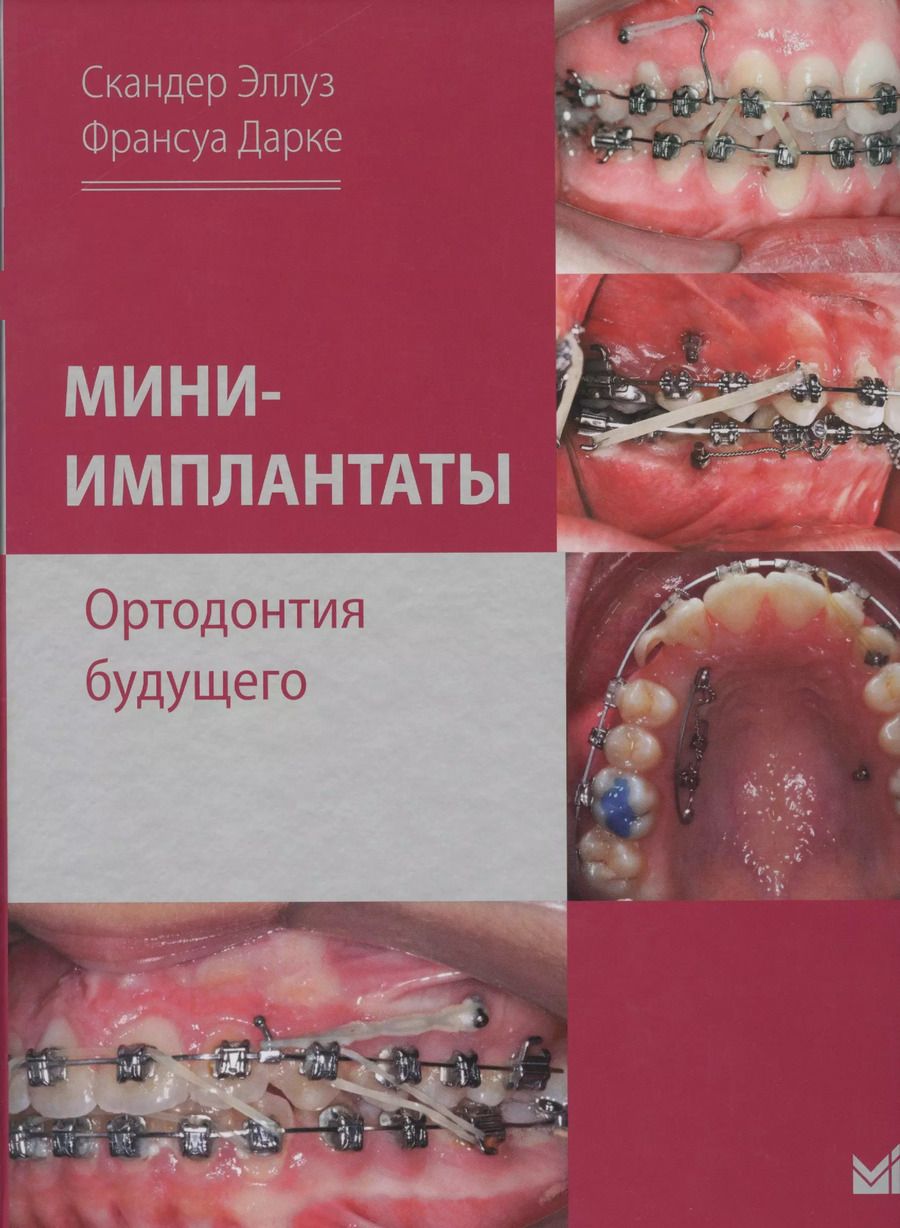 Обложка книги "Скандер Эллуз: Мини-имплантаты. Ортодонтия будущего."