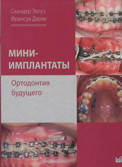 Обложка книги "Скандер Эллуз: Мини-имплантаты. Ортодонтия будущего."